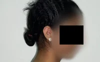 Maroc : les chirurgiens retirent 27 % du poids d'une adolescente