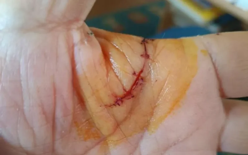 Carrefour refuse d'indemniser Abdel, grièvement blessé par l'explosion d'une bouteille de vin