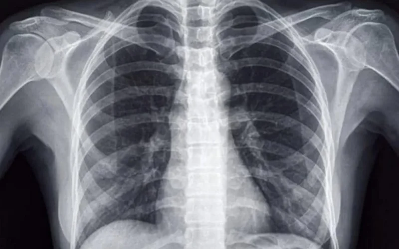 Maroc : une anomalie génétique rare révélée