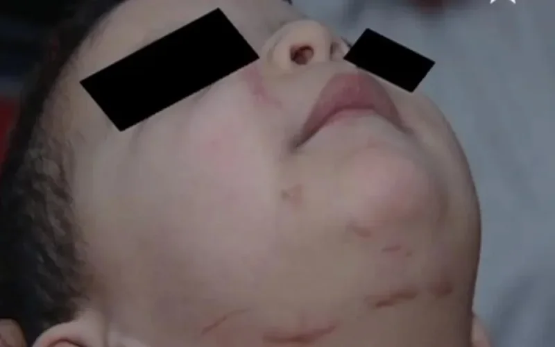 Vidéo : Rayan, 3 ans, défiguré par un pitbull