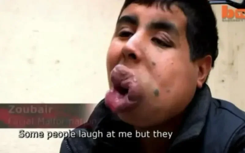 Etats-Unis : un Marocain retrouve son visage après 7 opérations (vidéo)