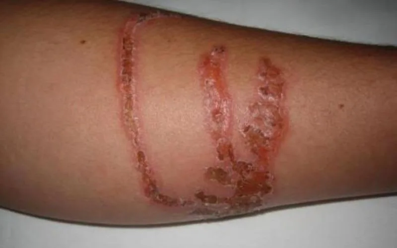 Une méduse dangereuse repérée sur les côtes marocaines