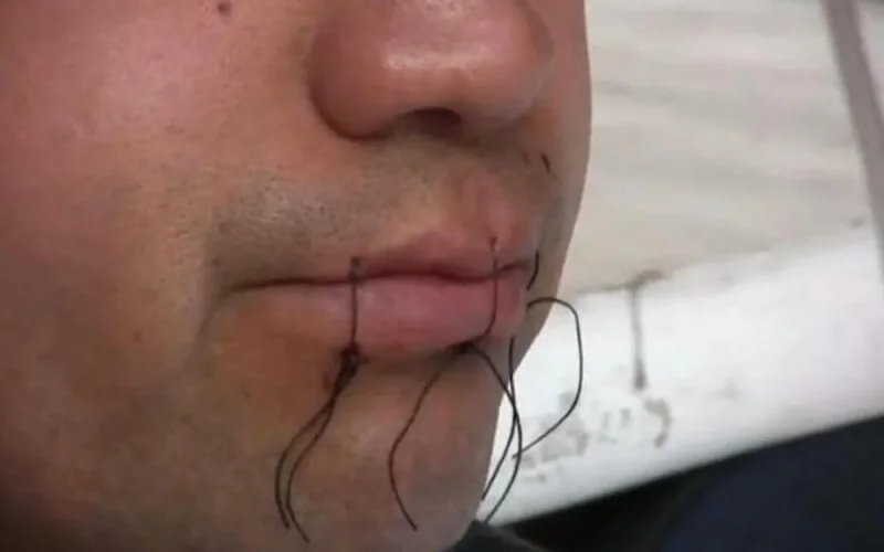 France : menacé d'expulsion, un Marocain se coud les lèvres