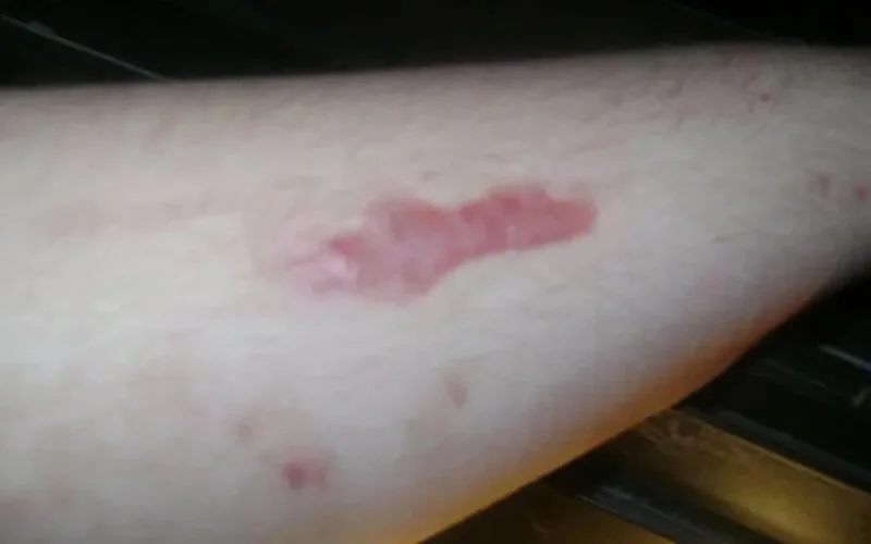 Italie : une Marocaine condamnée pour avoir brûlé son fils avec un fer à repasser