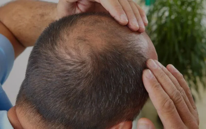 Pour la transplantation de cheveux, les Marocains choisissent la Turquie