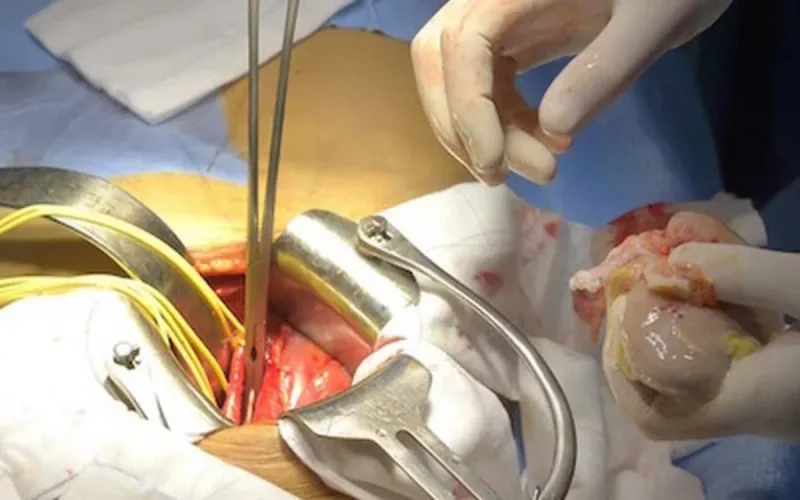 Première médicale à l'Hôpital Universitaire International Cheikh Khalifa