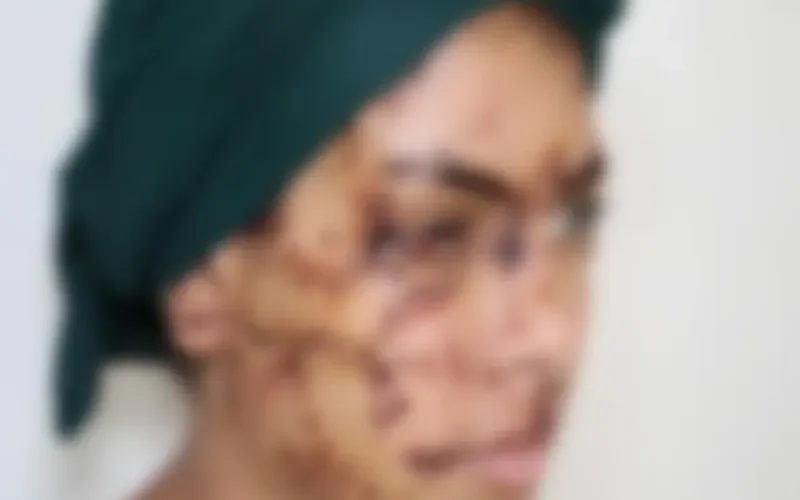 Affaire Imane à Taza : 15 ans de prison pour l'ex-mari qui avait défiguré son épouse