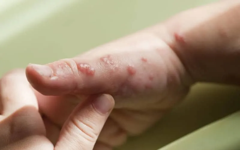 Le Maroc veut s'approvisionner en médicament contre la variole du singe