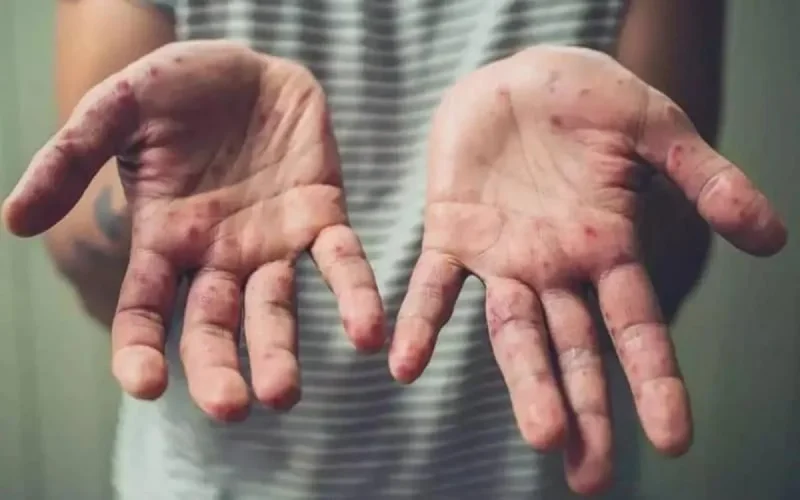 Variole de singe : un touriste français positif à Marrakech