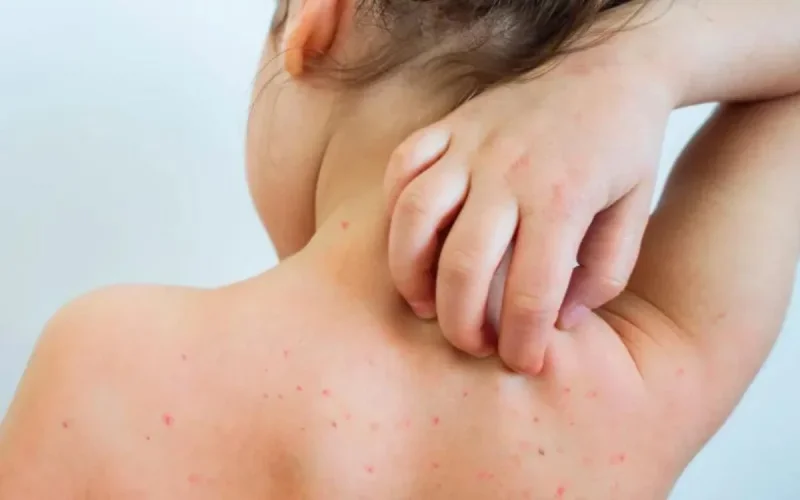 À Bruxelles, détection d'un dangereux variant de rougeole originaire du Maroc