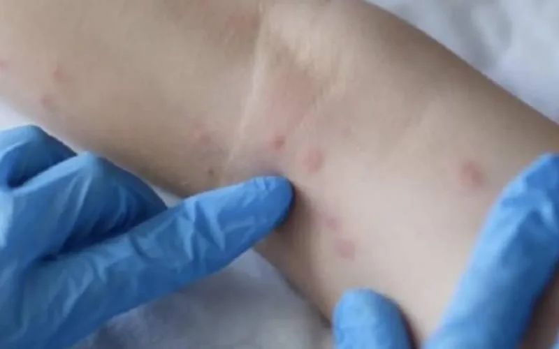 Variole du singe : voici le protocole adopté par le Maroc