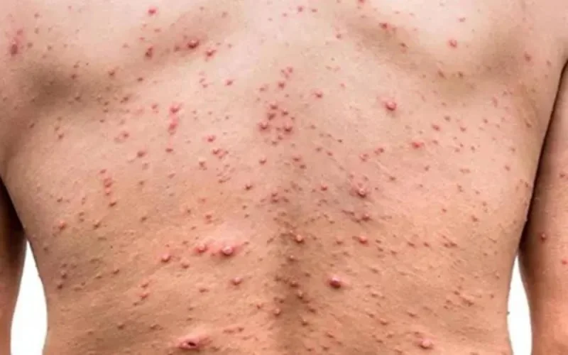 Variole du singe : le Maroc se met en état d'alerte