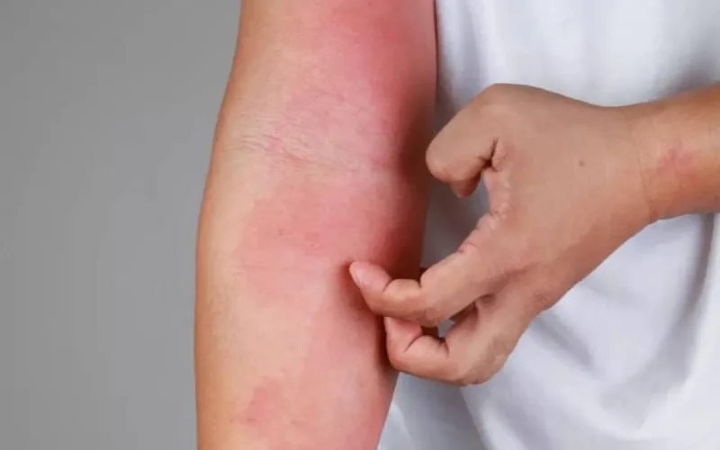 Variole du singe : les cas suspectés au Maroc sont négatifs