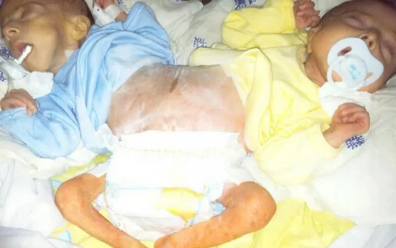 Des jumeaux siamois menacés d'expulsion de l'hôpital de Rabat