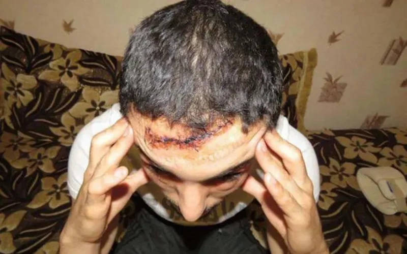 France : la police accusée de bavure après une blessure au flash-ball