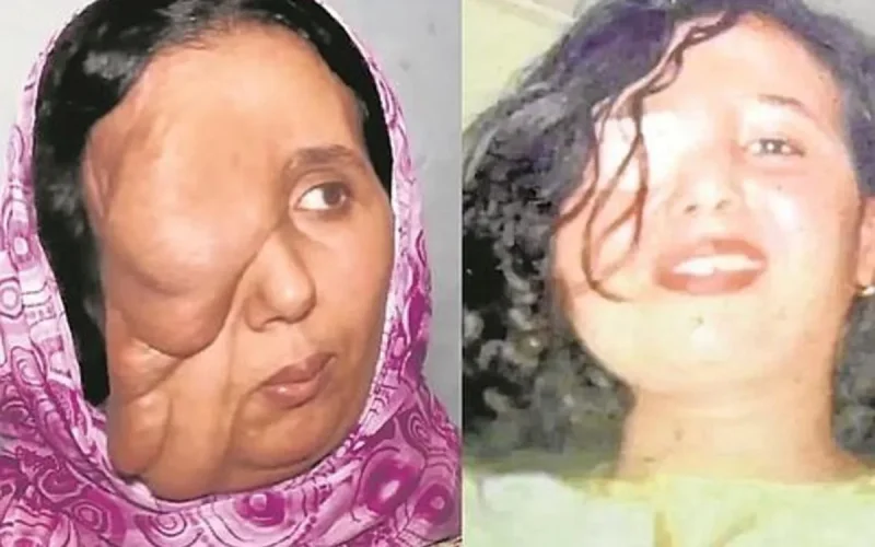 Grâce à un chirurgien espagnol, une Marocaine retrouve un visage plus humain