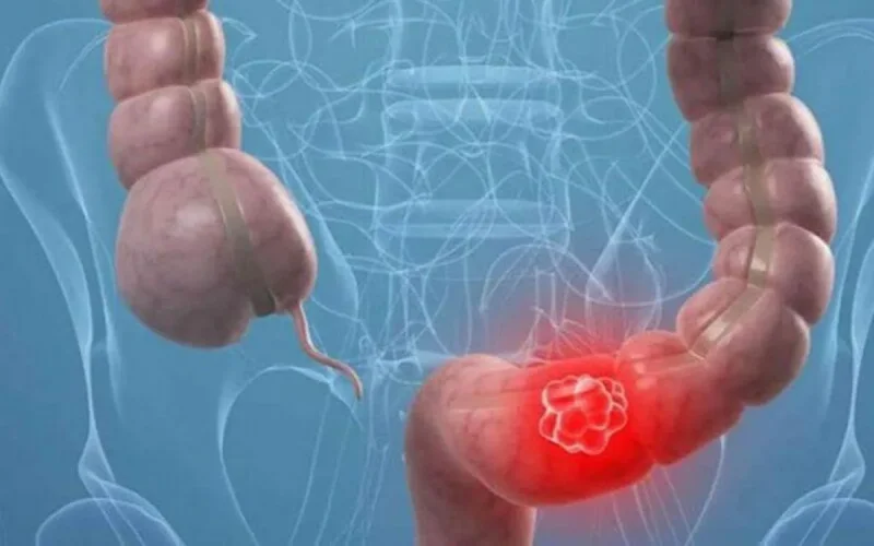 Cancer colorectal : une étude marocaine désigne les produits laitiers comme facteurs de protection