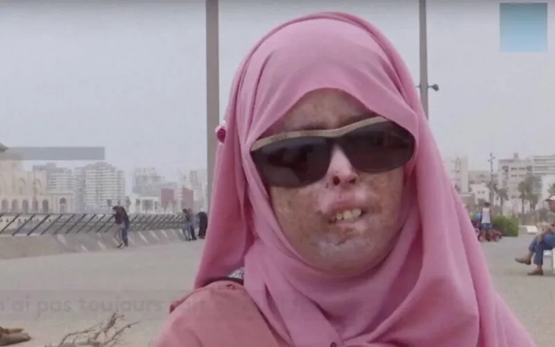Le Xéroderma pigmentosum, l'allergie qui tue les enfants marocains (vidéo)