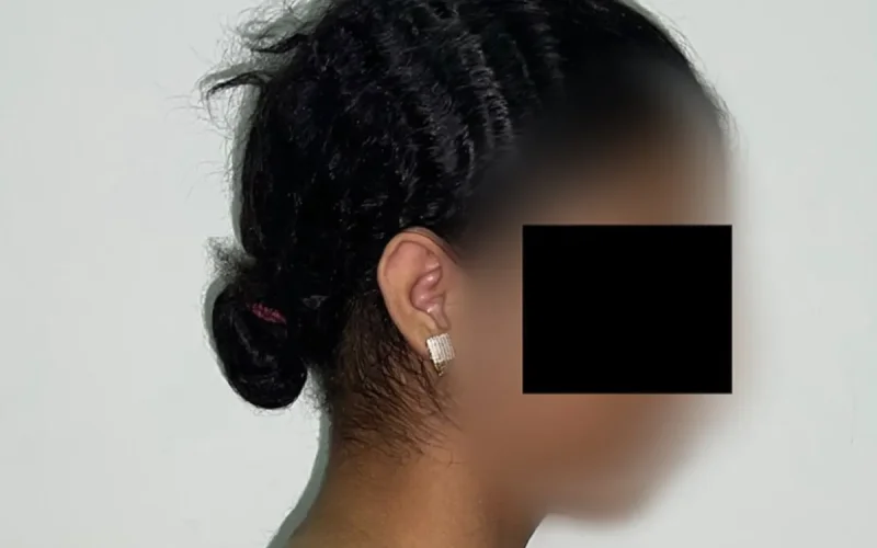 Maroc : les chirurgiens retirent 27 % du poids d'une adolescente