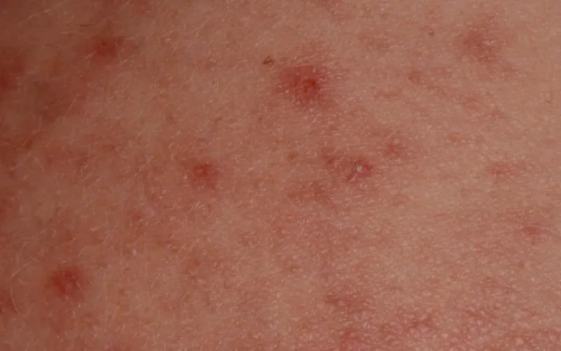 Épidémie de rougeole au Maroc : grosses inquiétudes en France 