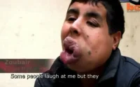 Etats-Unis : un Marocain retrouve son visage après 7 opérations (vidéo)