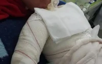 France : SOS pour sauver un enfant marocain brûlé au 3e degré
