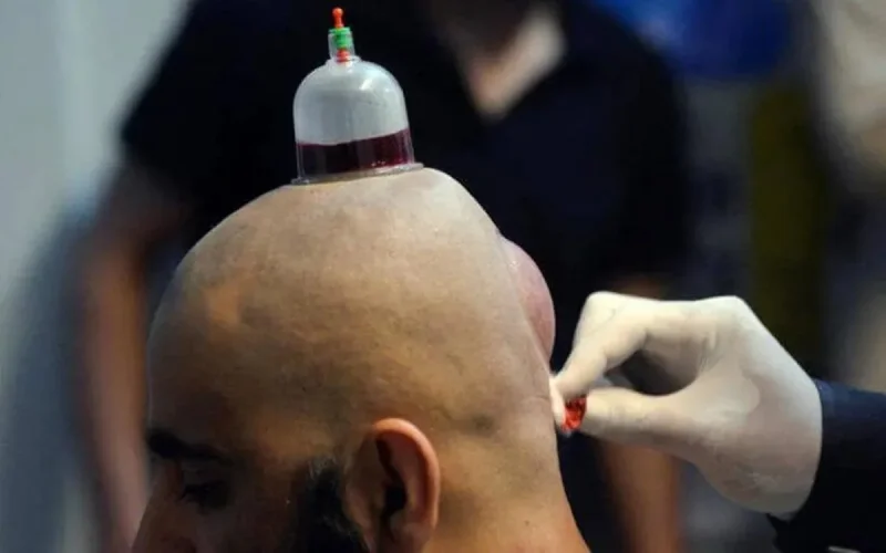Seine-Saint-Dénis : arrestation d'un couple pour pratique de la Hijama