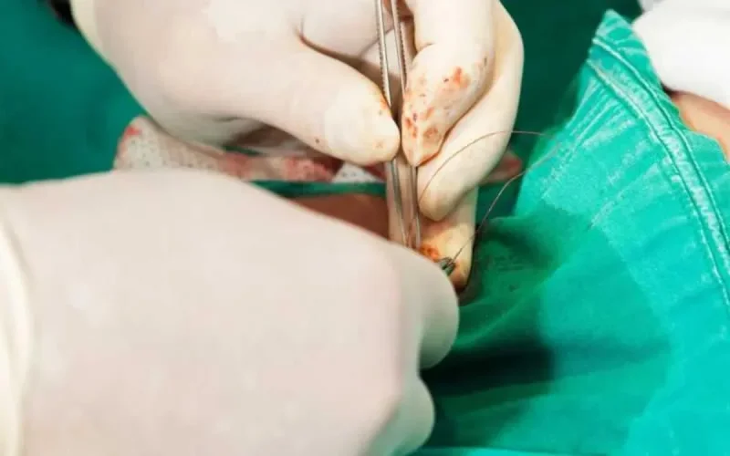 Une circoncision ratée fait condamner à un médecin à 10 millions de dirhams